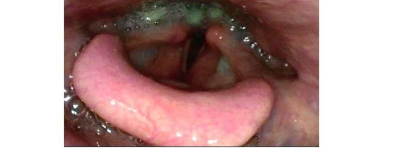 ORL klinika dnes nabízí vyšetření zaměřené na obtíže při polykání